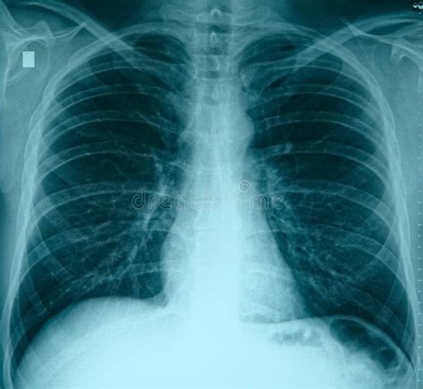 平胸X光正常健康肺 库存照片 图片 包括有 视图 扫描 骨头的 医学 男人 人力 诊断