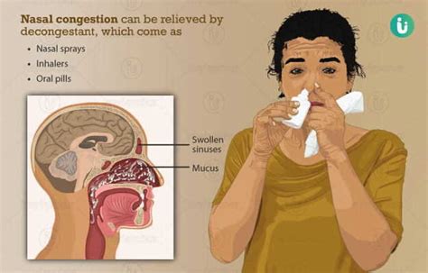 Blocked Nose Nasal Congestion Symptoms Causes Treatment Medicine