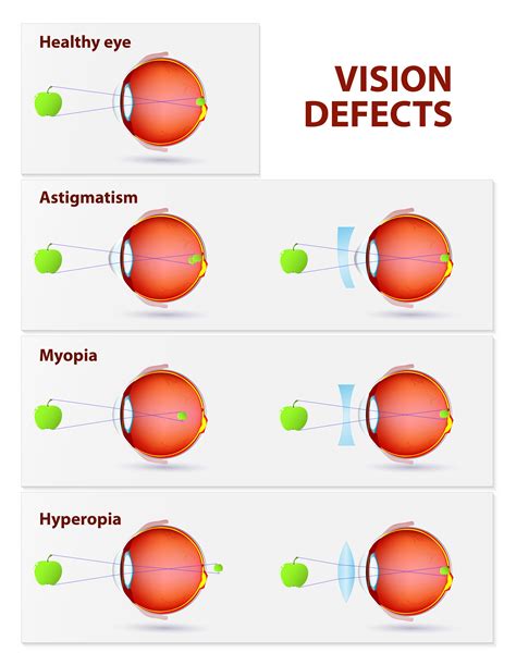 Types Of Vision Problems Refractive Surgery Corrects Rsc