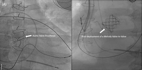 A Fluoroscopy Of The Original Surgical Aortic Valve Replacement Savr