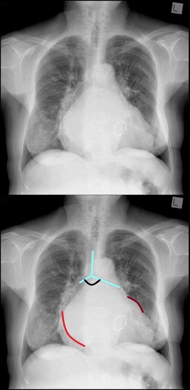 Cxr Left Atrium On Chest X Ray Heart