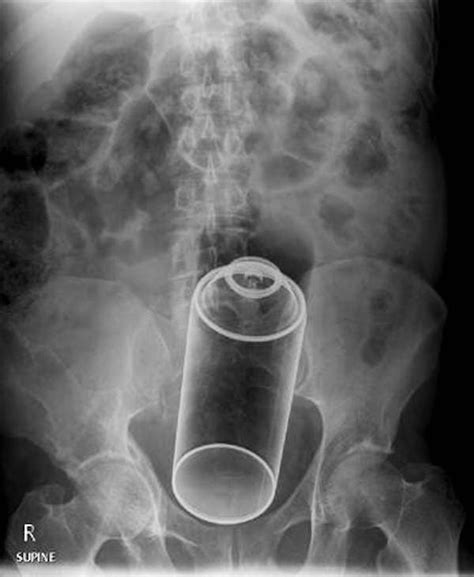 website compiles x ray photos of weird things stuck up people s butts
