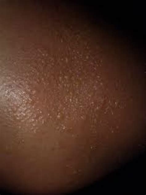 Atopic Eczema On Black Skin