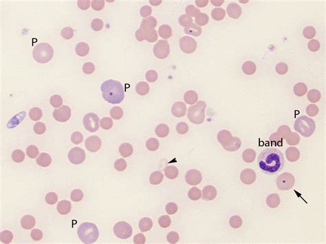 Immune Mediated Hemolytic Anemia In A Dog Eclinpath