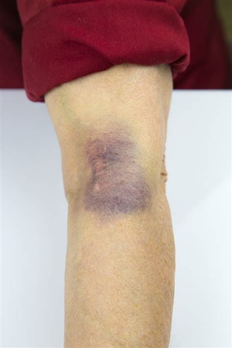 127 Bruises Contusion Photos Free And Royalty Free Stock Photos From