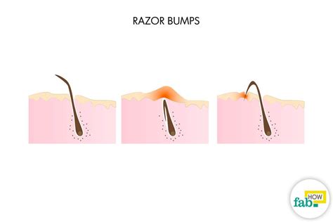How To Get Rid Of Razor Bumps Fast With Home Ingredients Fab How