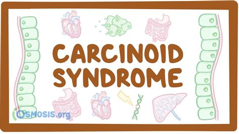 Carcinoid Syndrome Causes Symptoms Diagnosis Treatment Pathology