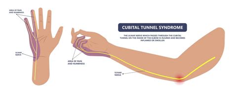 Cubital Tunnel Syndrome What It Is And What You Can Do About It