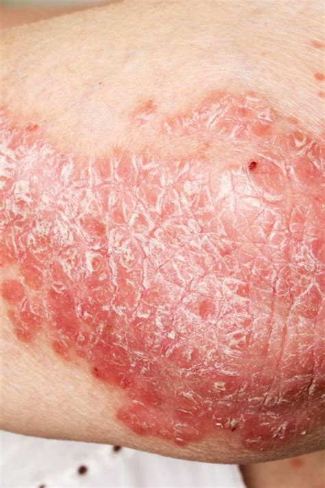 Psoriatic Arthritis Rash Pictures Symptoms And Treatment