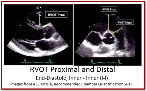 7 Tips To Implementing Rv Size Quantification Cardioserv