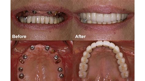 Dental Implants Before And After Dr Ari Greenspan Dentist
