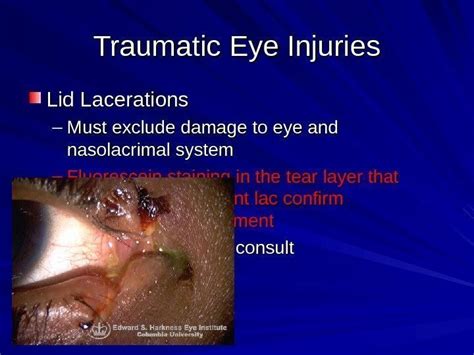 Traumatic Eye Injuries By Barakzay Dastagir Traumatic