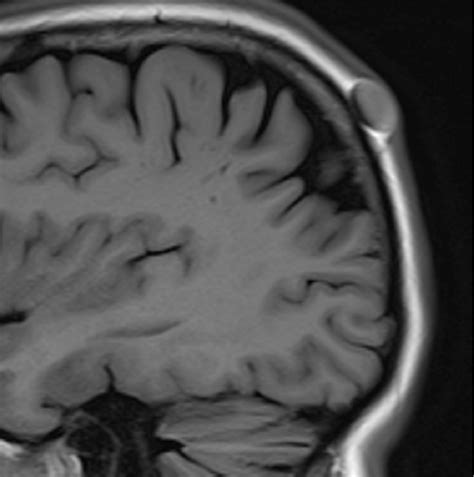 Scalp Lesions Incidentally Discovered On The Mri Scans Of The Head