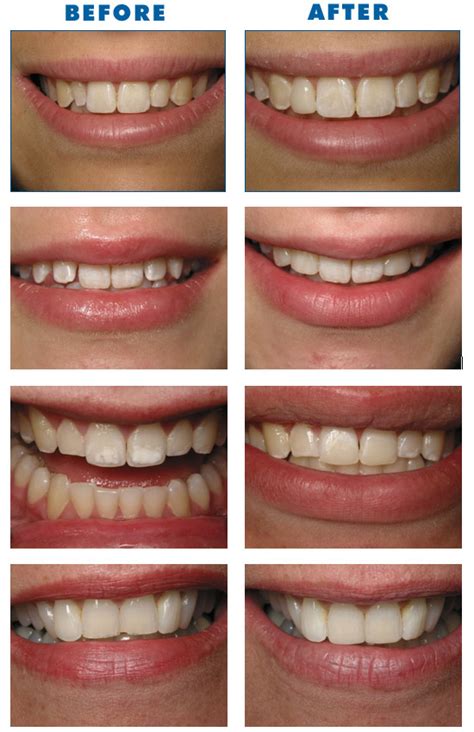 Cosmetic Bonding Procedures | Dr. Nechupadam Dental Clinic