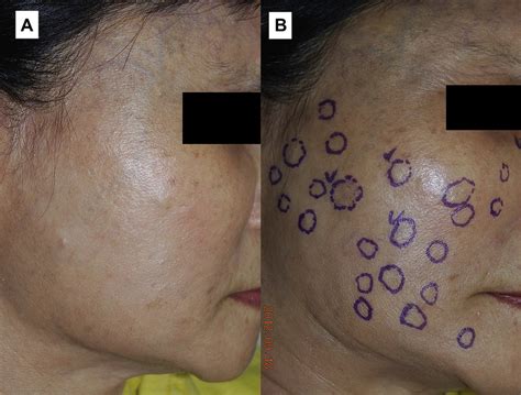 A Multiple Firm Skin Colored Papules And Subcutaneous Nodules On The