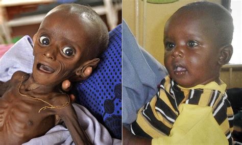 Minhaj Gedi Farah Starving African Famine Poster Child Has Now Fully