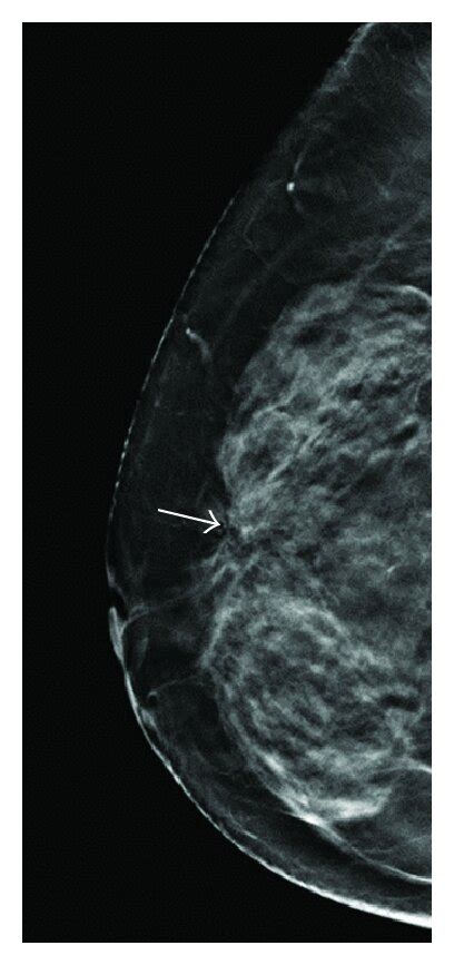 A 59 Year Old Woman For Mammographic Screening A Digital Mammogram