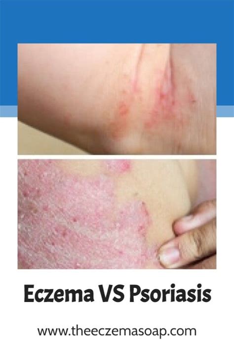 Eczema Vs Psoriasis What To Know Psoriasis Eczema Eczema Psoriasis