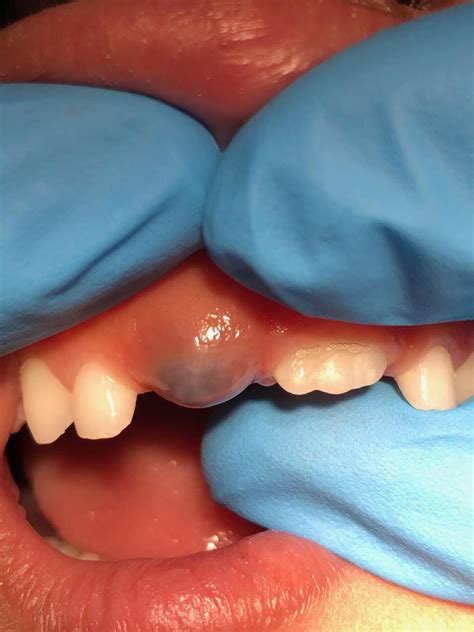 A Purple Blue Bump On Childs Gum Eruption Cyst Eruption Hematoma