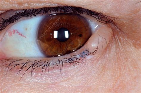 Molls Cyst In The Eyelid Stock Image C0139726 Science Photo Library