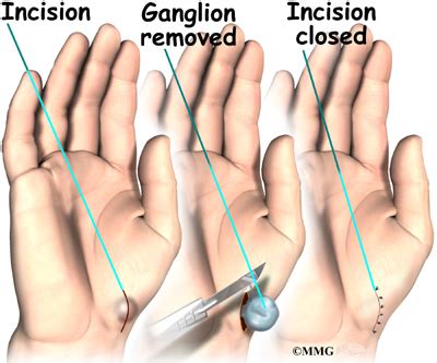 Ganglion Cyst Removal Specialist Bone Clinic Neurosurgeon