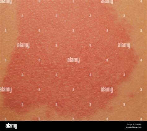 Skin Burn Shoulder High Resolution Stock Photography And Images Alamy