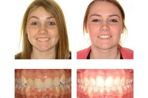 Gummy Smiles Gallery Thames Orthodontics