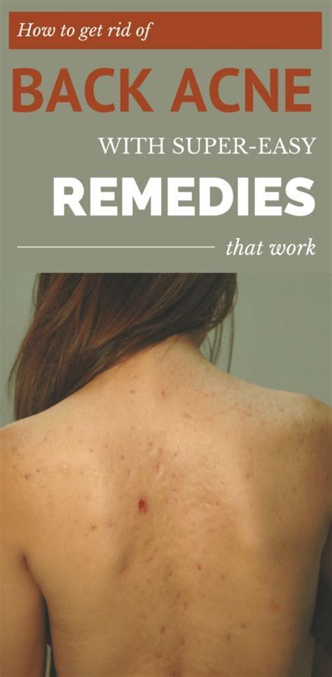 How To Get Rid Of Back Acne With Super Easy Remedies That Work