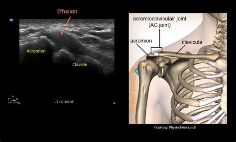 Acromioclavicular AC Joint Anatomy On POCUS Abhilash GrepMed