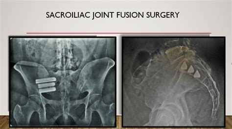 Sacroiliac Joint Si Fusion Dr Todd Jackman Stillwater Spine Surgeon