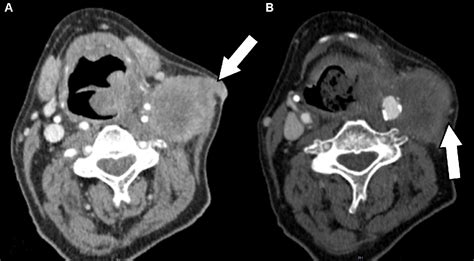 Figure 2 From Radiological Assessment Of Extranodal Extension In