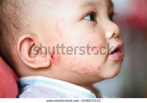 Eczema Atopic Baby Dermatitis Child Disease Stock Photo Edit Now