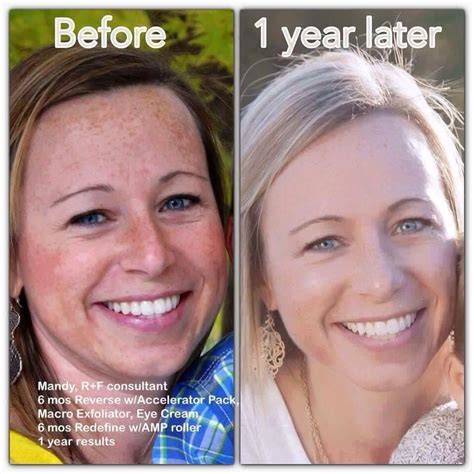 Rodan And Fields Spotless Before And After Talentwest