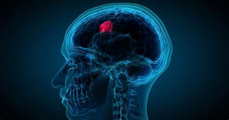 Los 20 Tipos De Tumores Cerebrales Características Y Síntomas