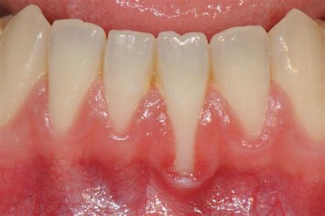 A 22 Year Old Man With Gingival Recession In The Mandibular Left