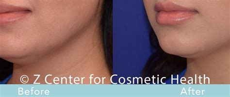 Coolsculpting Double Chin Before And After 7 Zcosmetic Health