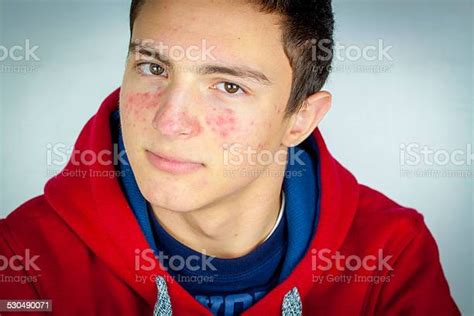 Portrait Of Teenage Boy With Acne Stock Photo Download Image Now