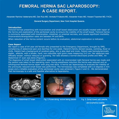 Femoral Hernia Sac Laparoscopy A Case Report Sages Abstract Archives