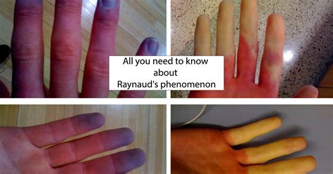 Raynauds Phenomenon Cause Symptoms Diagnosis And Treatment