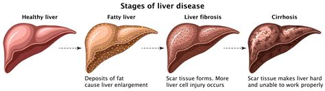 Liver Fibrosis Vs Cirrhosis Alpha Digestive Liver Centre