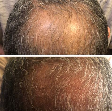 Exosome therapy is comparatively a safer option with no known major adverse effects. Exosome Therapy for Hair Loss in New York