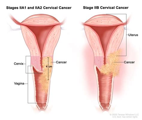 Cervical Cancer Vanderbilt Ingram Cancer Center