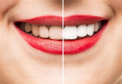 Professional Teeth Whitening From Your Dentist Marietta Ga