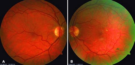 Scielo Brasil Congenital Retinal Macrovessel Associated With