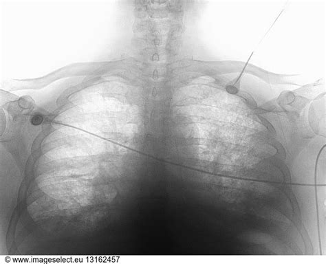 Chest X Ray Congestive Heart Failure Chest X Ray Congestive Heart