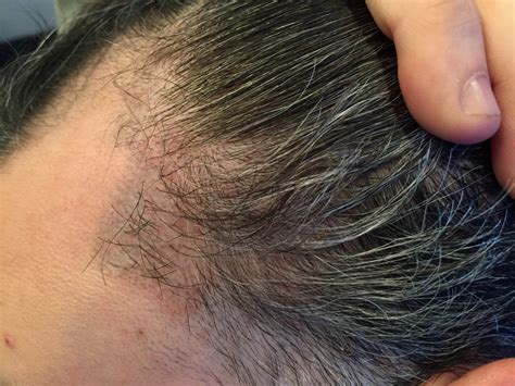 Botched Fue To Temporal Peaks Marc Dauer Md Hair Transplant Doctor