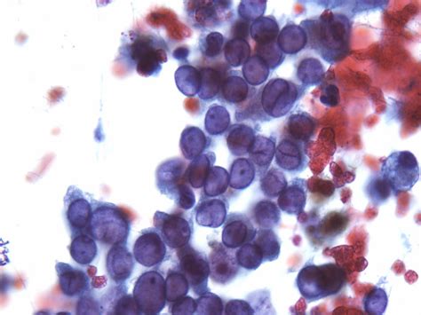 Fna Of Metastatic Papillary Thyroid Carcinoma Showing Characteristic Download Scientific