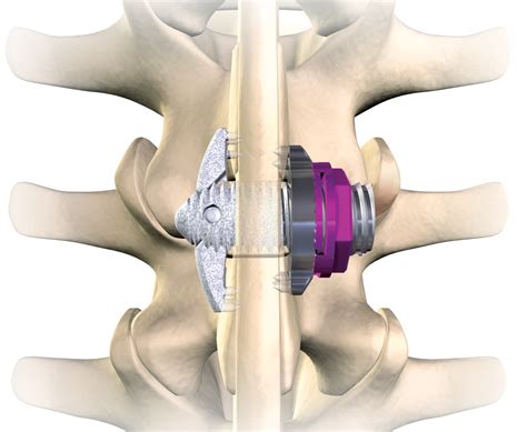 Spinal Fusion Nura Clinics