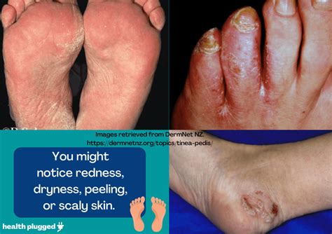 Tinea Pedis Symptoms Pictures Diagnosis Treatment Prevention