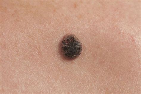 Signs Of Abnormal Moles And When They Should Be Removed Activebeat